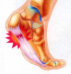 Plantar-Fasziitis