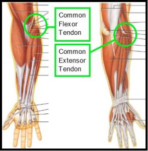 tennis elbow