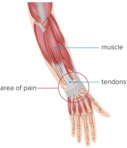 tendinitis de muñeca