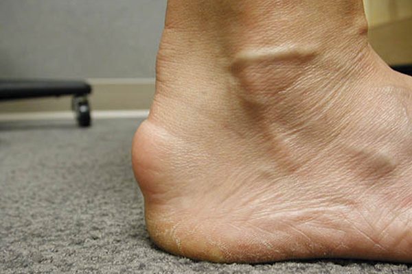 Achilles Bursitis Pictures​