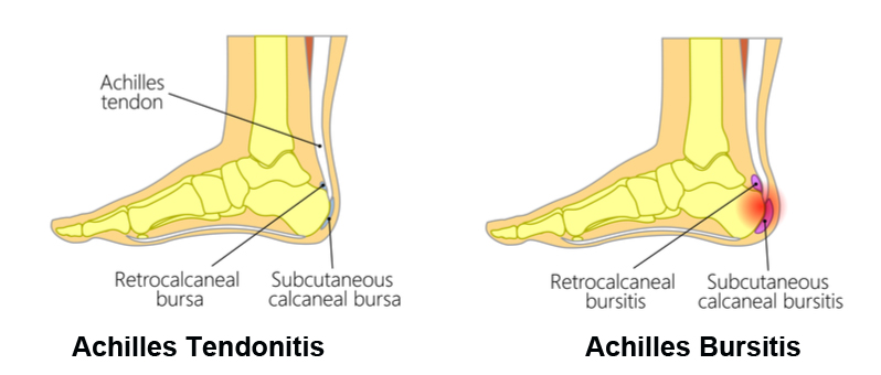 Achilles-Bursitis vs. Sehnenscheidenentzündung
