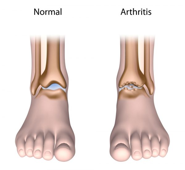 Knöchel-Osteoarthritis