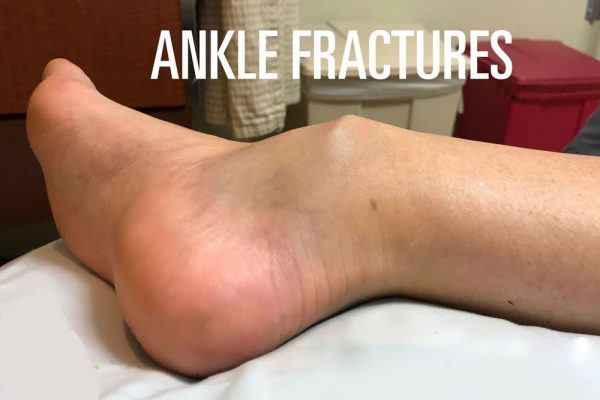 broken ankle symptom picture