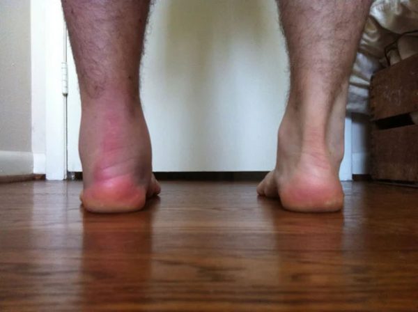 Achilles Tendonitis Symptoms Pictures