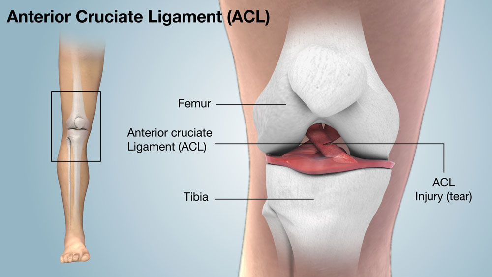 Introduction-to-ACL-tear