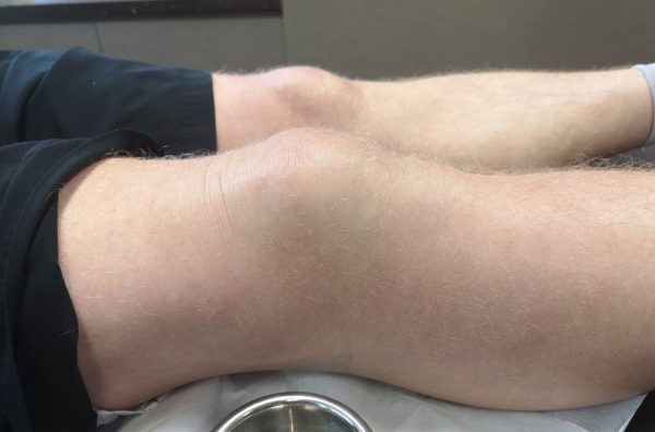 Image des symptômes de la bursite du genou