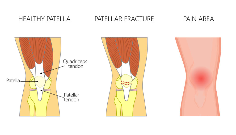 ¿Qué es una fractura de rodilla?