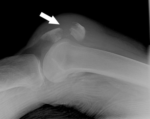 Patella (knee cap) fracture picture