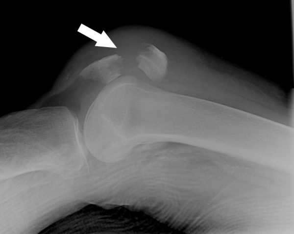 Imagen de fractura de rótula (rótula)