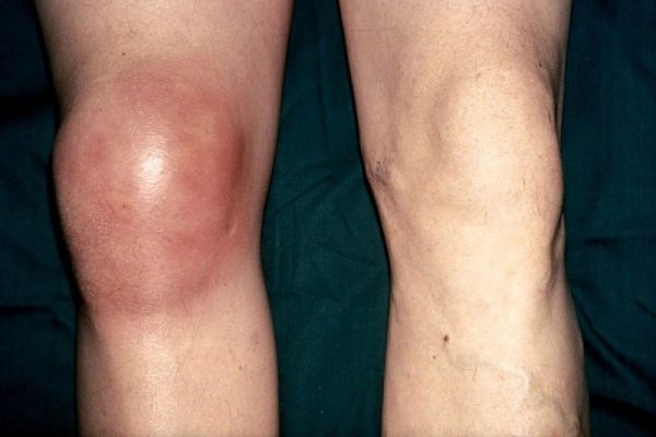 Verstauchtes-Knie-Symptom-Bild