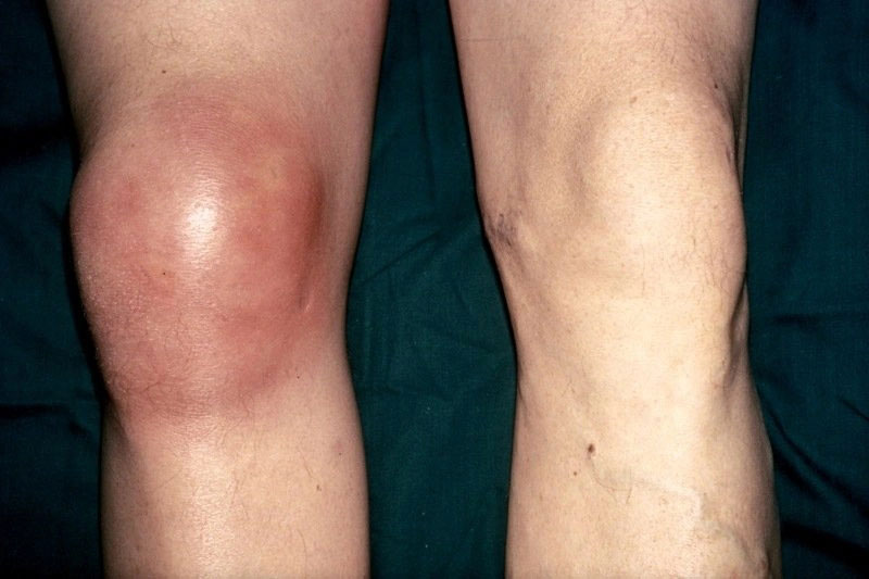 Knee Is Swollen And Hot Knee Swelling YEQPG
