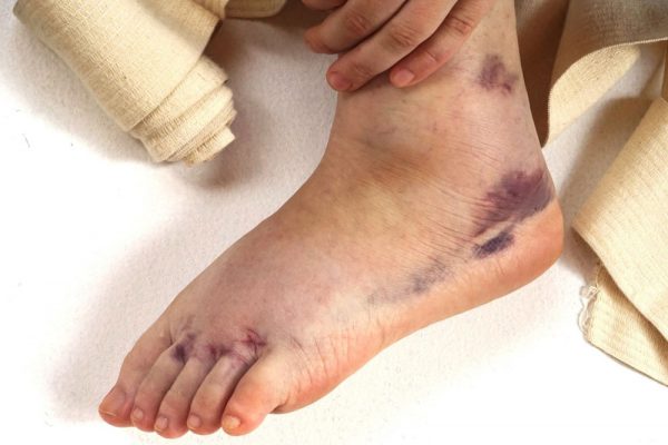 Sprained ankle symptom picture