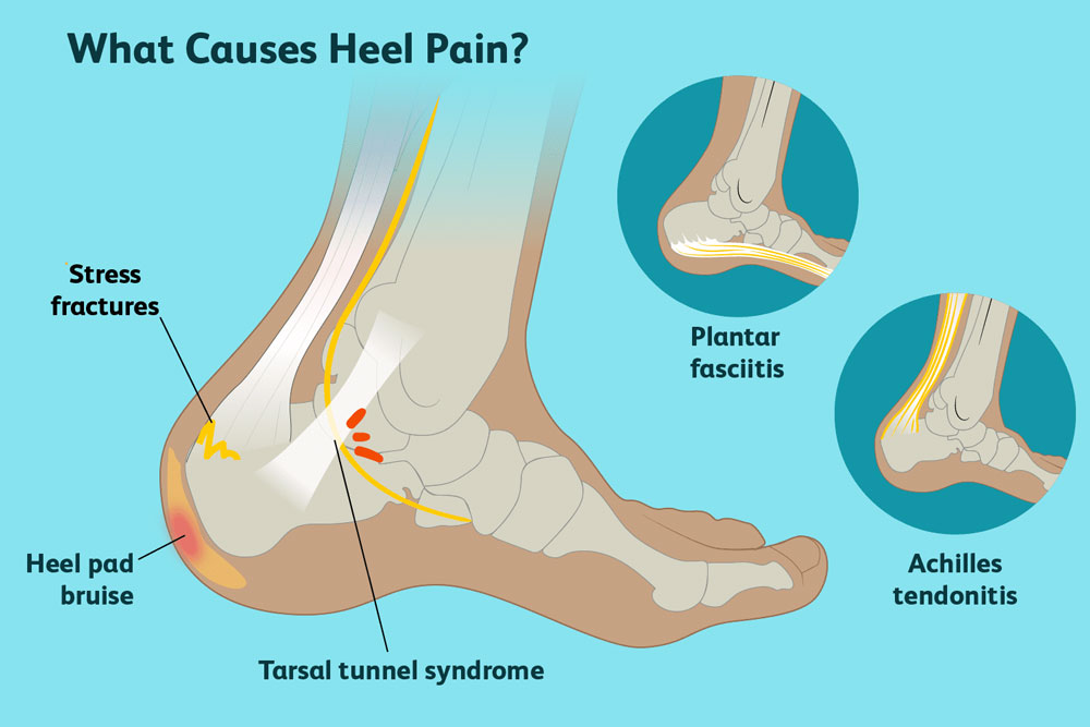 ¿Qué causa el dolor de talón?
