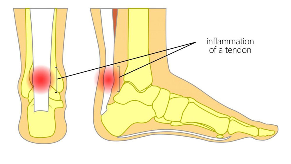 What Is the Achilles Tendon?