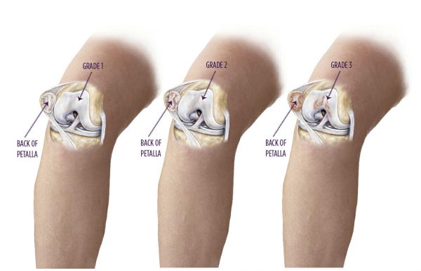Chondromalazie Grad 2 Bis 3 www.worldbrace.com