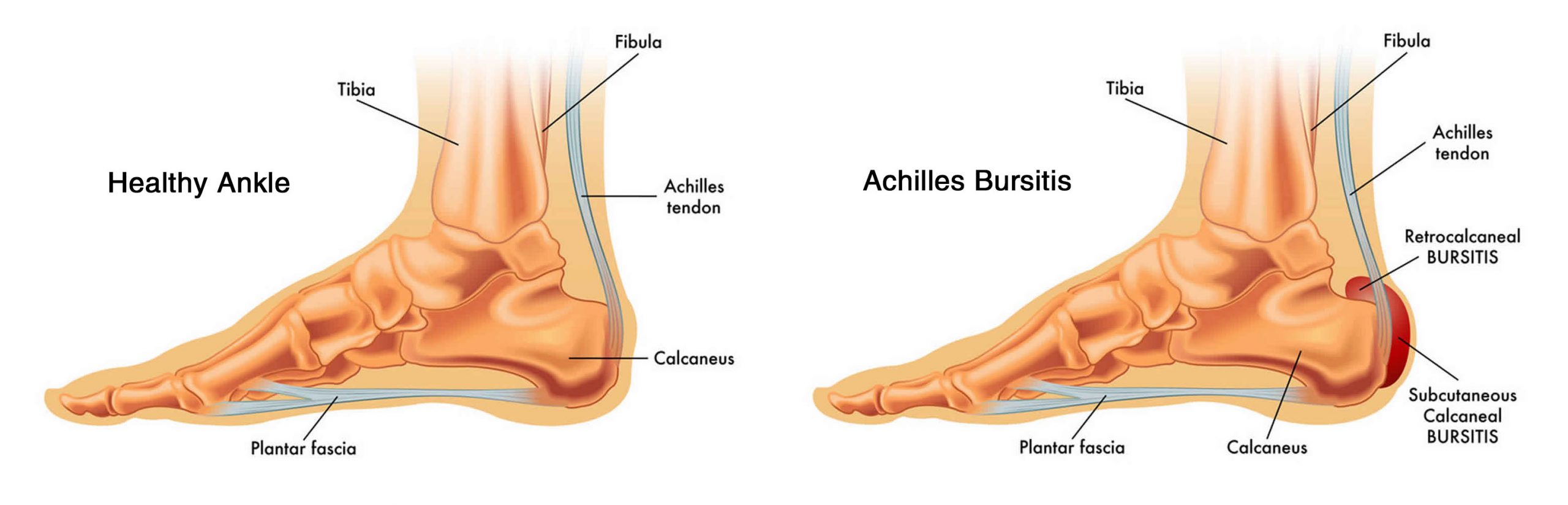 ¿Qué es la bursitis de Aquiles?