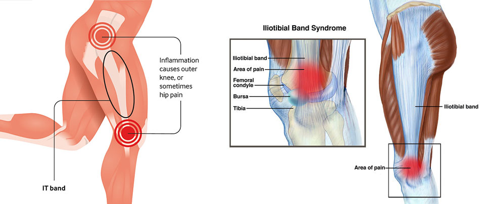 What is IT band syndrome