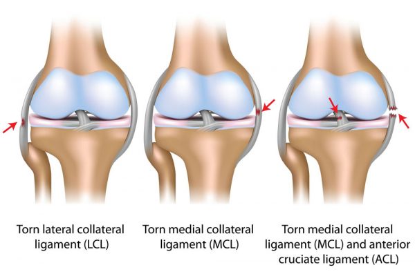 What is knee hyperextension?