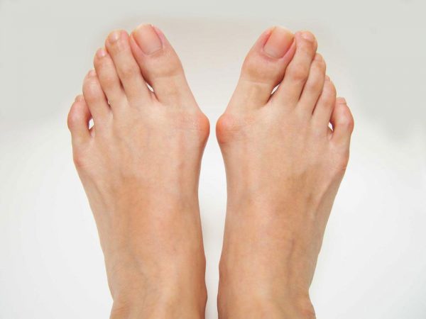 Bunions Symptom Picture