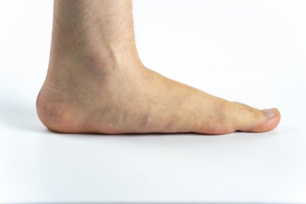 pied plat-symptôme-image