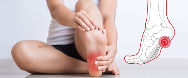 plantar-fasciitis