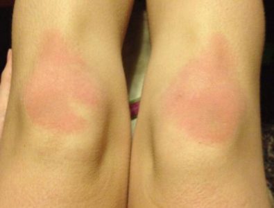 Brennendes Knie Symptom Bild wahr