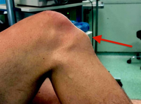 Symptombild der Osgood-Schlatter-Krankheit