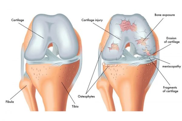 Osteoarthritis-knee