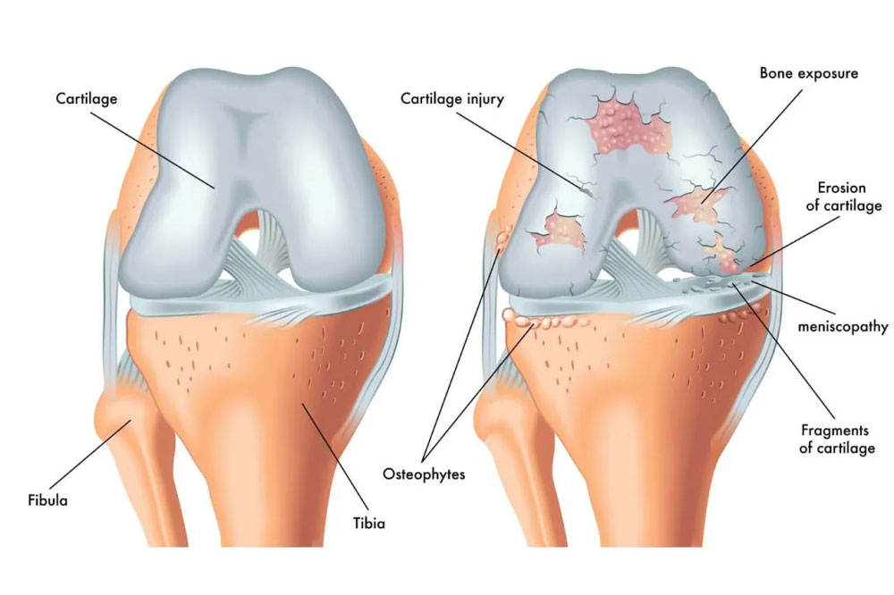 Claquement des genoux : symptômes, causes, traitement par ...