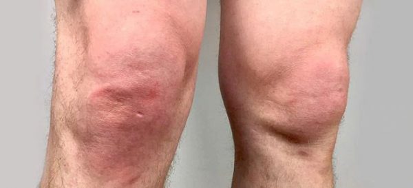 Image des symptômes de l'arthrose du genou