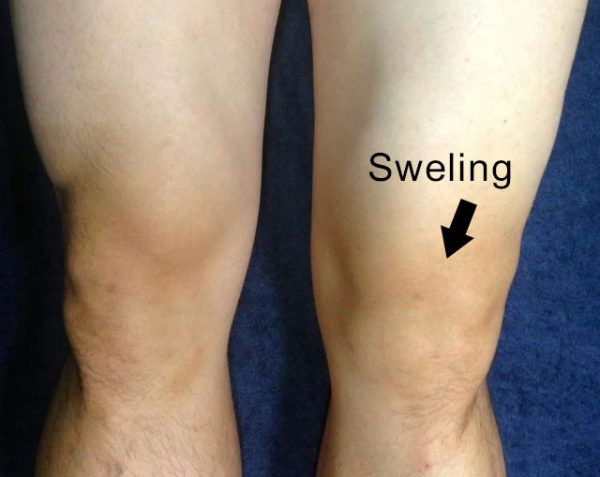 Quadro de sintomas do joelho inchado