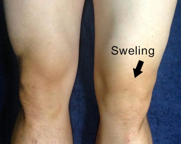 Swollen Knee symptom picture