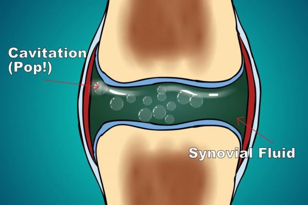 ¿Qué causa el chasquido de rodilla?