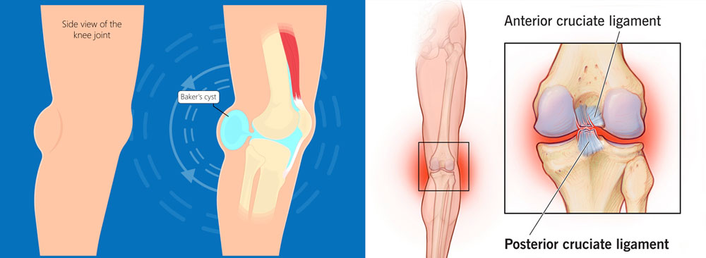 What Is Behind Knee Pain