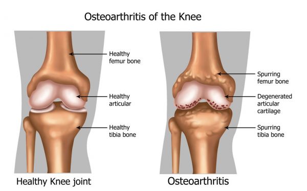 O que é osteoartrite do joelho