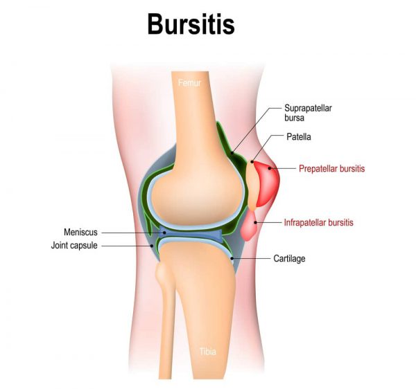 What causes a stiff knee