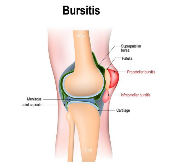 Was verursacht ein steifes knie