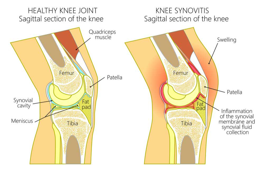 Was ist Flüssigkeit im Knie?