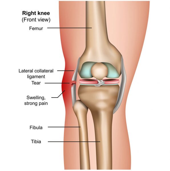 What is LCL Tear