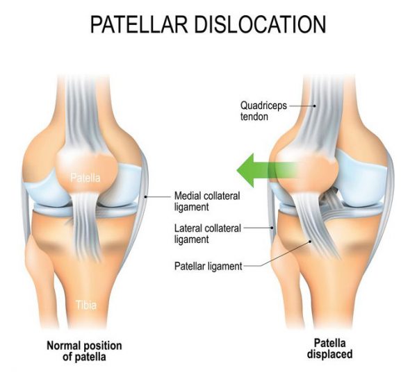 Was ist eine Patellaluxation?