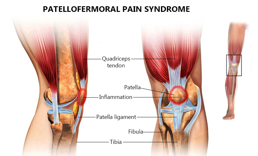 What is Patellofemoral Pain