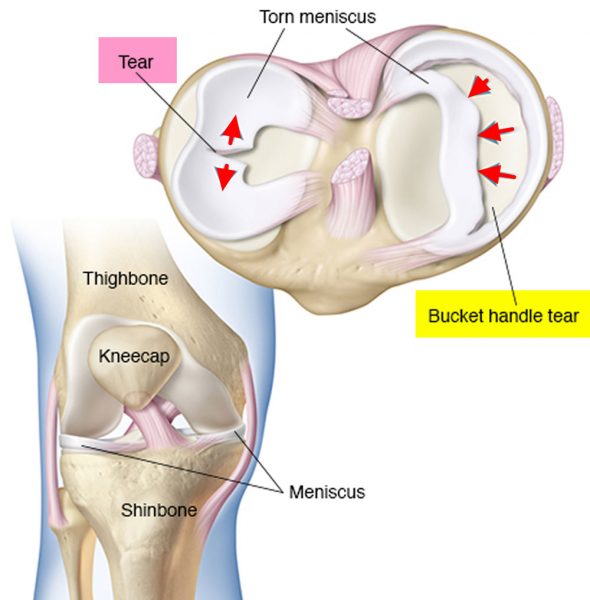 What is a meniscus injury