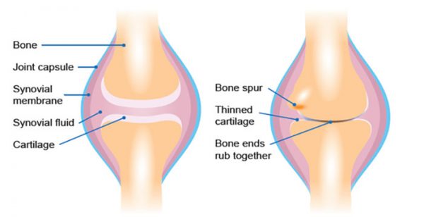 What is a stiff knee