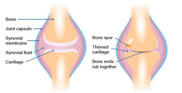 Was ist ein steifes knie