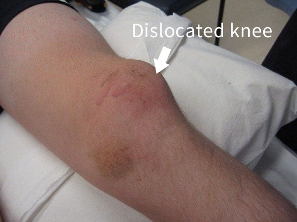 photo des symptômes du genou disloqué