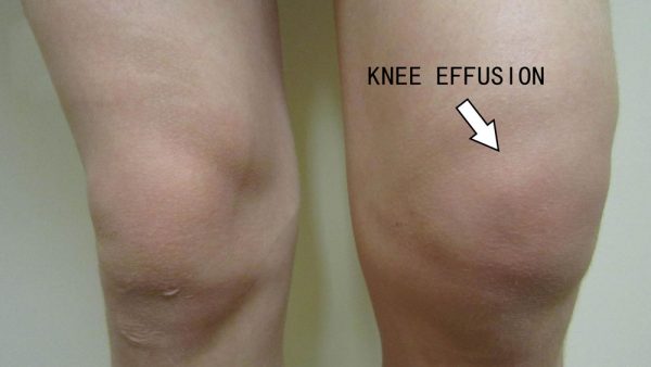quadro de sintomas de derrame no joelho