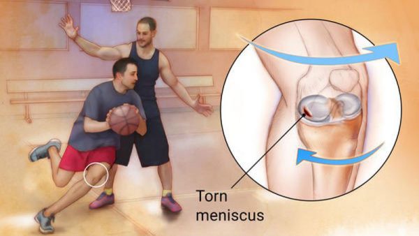 meniscus injury