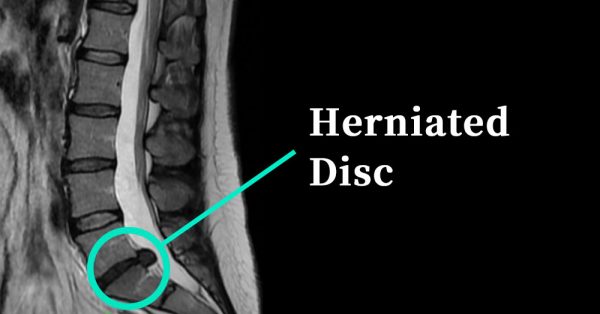 Herniated disc symptom picture