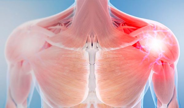 Woran erkennt man Schultersehnenschmerzen?
