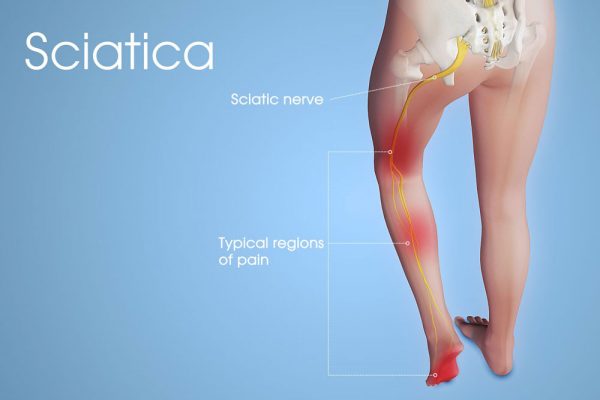 Como aliviar a dor ciática